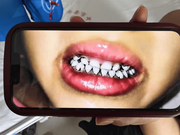 家长接到劝返电话“回甘肃去治”，幼儿血铅中毒事件更多细节曝光