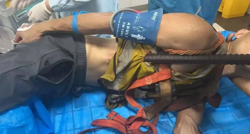 佛山一男子意外从高空坠落,1.5米长钢筋从肛门贯穿胸腔......