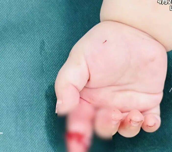 山东一妈妈抱着7月大女儿用剪刀拆快递，不慎把女儿右手食指剪断，孩子爸爸在沙发缝中找到断指后送医，3个多小时手术后手指被成功接上